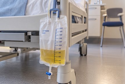 Dunkles Blut im Katheterbeutel - Bettbeutel hängend am Bett mit Urin