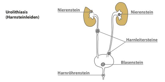 Dunkles Blut im Katheterbeutel: Urolithiasis (Harnsteinleiden) - Blasensteine oder Nierensteine